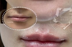 玻尿酸丰脸颊价格差异大吗？如何选择？