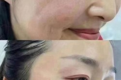 美容祛皱哪种方法最有效？多少钱一次？