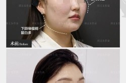 下颚骨整形多少钱？下颚骨整形手术风险和注意事项有哪些？