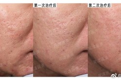 像素激光治疗痘疤效果怎样？治疗周期需要多久？