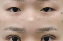 单眼皮变双眼皮手术安全吗？效果怎么样？