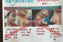 隆鼻技术有哪些新发展？哪种最安全？