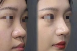 怎么做鼻孔缩小手术？手术效果自然吗？