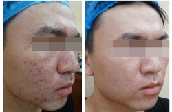 治疗痤疮医院哪家好？如何做到根治痘痘？