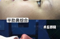 朝天鼻纠正整形有哪些方法？哪种最好？