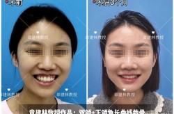 下颌角肥大手术需要多少钱？如何选择医院？