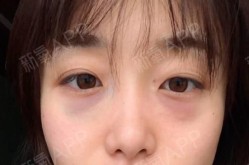 眼袋整形手术恢复期多久，效果自然吗？
