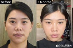 脸型上窄下宽如何改善？有没有非手术方法？