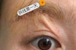 种植眉毛安全吗？手术过程是怎样的？