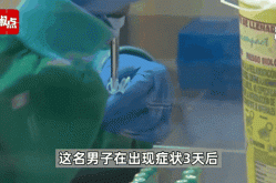 意大利男子同时感染猴痘新冠与艾滋（猴痘和艾滋病有关系吗）