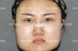 改脸型手术需要多少钱？术后恢复期是多久？