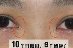 开眼角手术效果自然吗？会不会留下疤痕？