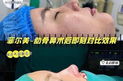 鼻尖整形手术效果好吗？有没有什么风险？