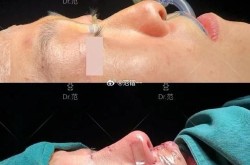 垫鼻子手术前后有哪些注意事项？