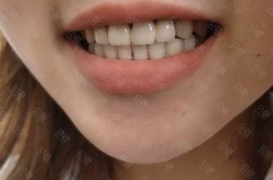钯银烤瓷牙的使用寿命和价格如何？值得选择吗？