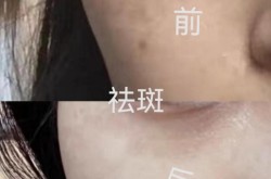 祛斑价格大概是多少？有没有什么副作用？