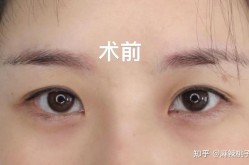 割双眼皮的坏处有哪些？如何避免？