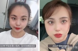 双眼皮整容手术前后需要注意什么？如何避免风险？