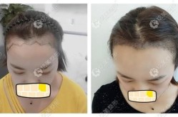 毛发种植手术费用高吗？效果能维持多久？