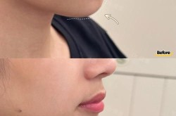 垫下巴前后对比图，垫下巴手术效果如何？