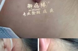 冷冻点痦子安全吗？和激光去斑哪个更有效？