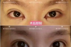 北京哪弄双眼皮好？如何找到技术精湛的双眼皮整形医生？