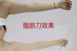 射频瘦小腿效果如何？有没有副作用？