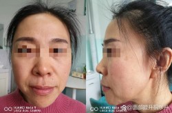 瓜子脸整形手术恢复期是多久？需要注意什么？