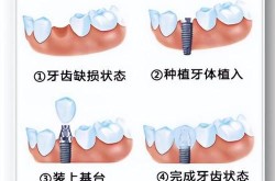 镶牙过程是怎样的？镶牙与传统假牙有哪些优势？