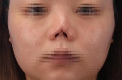 畸形鼻子整形难度大吗？术后效果怎么样？