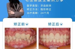 美容冠矫正龅牙效果怎么样？费用介绍