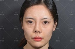 鼻部手术失败案例有哪些？如何避免手术风险？