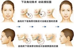 下颌磨骨要多少钱？手术风险大吗？