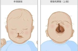 腭裂手术的费用大概是多少？几岁做比较合适？