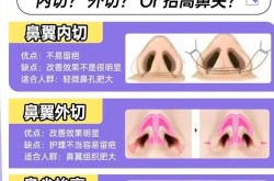 鼻翼整形一般需要多少钱？效果可以维持多久？