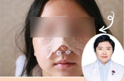 鼻头整形多少钱？术后需要注意什么？
