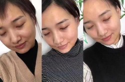 打美白针的医院哪家好？效果可以维持多久？