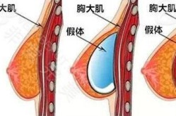 男变女手术隆胸过程复杂吗？需要注意哪些风险？