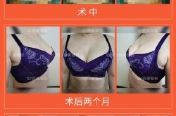 丰胸整形要多少钱？丰胸手术有哪些类型？
