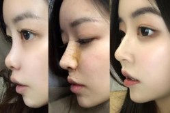 人工骨粉隆鼻安全吗？效果怎么样？