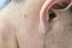 皮肤美容科常见问题有哪些？该如何解决？