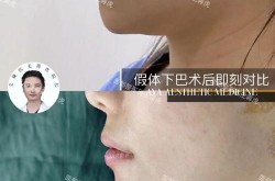 下颌角整形手术案例分享，效果真的那么好吗？
