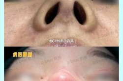 朝天鼻矫正手术风险大吗？如何选择正规医院？