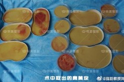 隆乳整形手术安全吗？术后需要注意些什么？