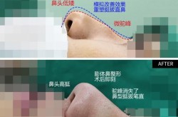 驼峰鼻手术费用大约是多少？恢复期多久？