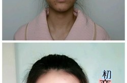 整形前后对比照如何看？有哪些需要注意的细节？
