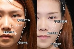 面部下垂整形有哪些方法？哪种最有效？