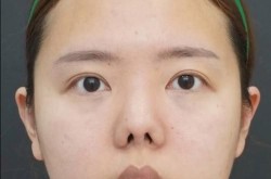 朝天鼻整容手术复杂吗？术后护理有哪些要点？