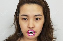 嘉兴美容医院做双眼皮怎么样？求经验分享