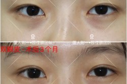 双眼皮手术前后对比照变化大吗？恢复期多久？